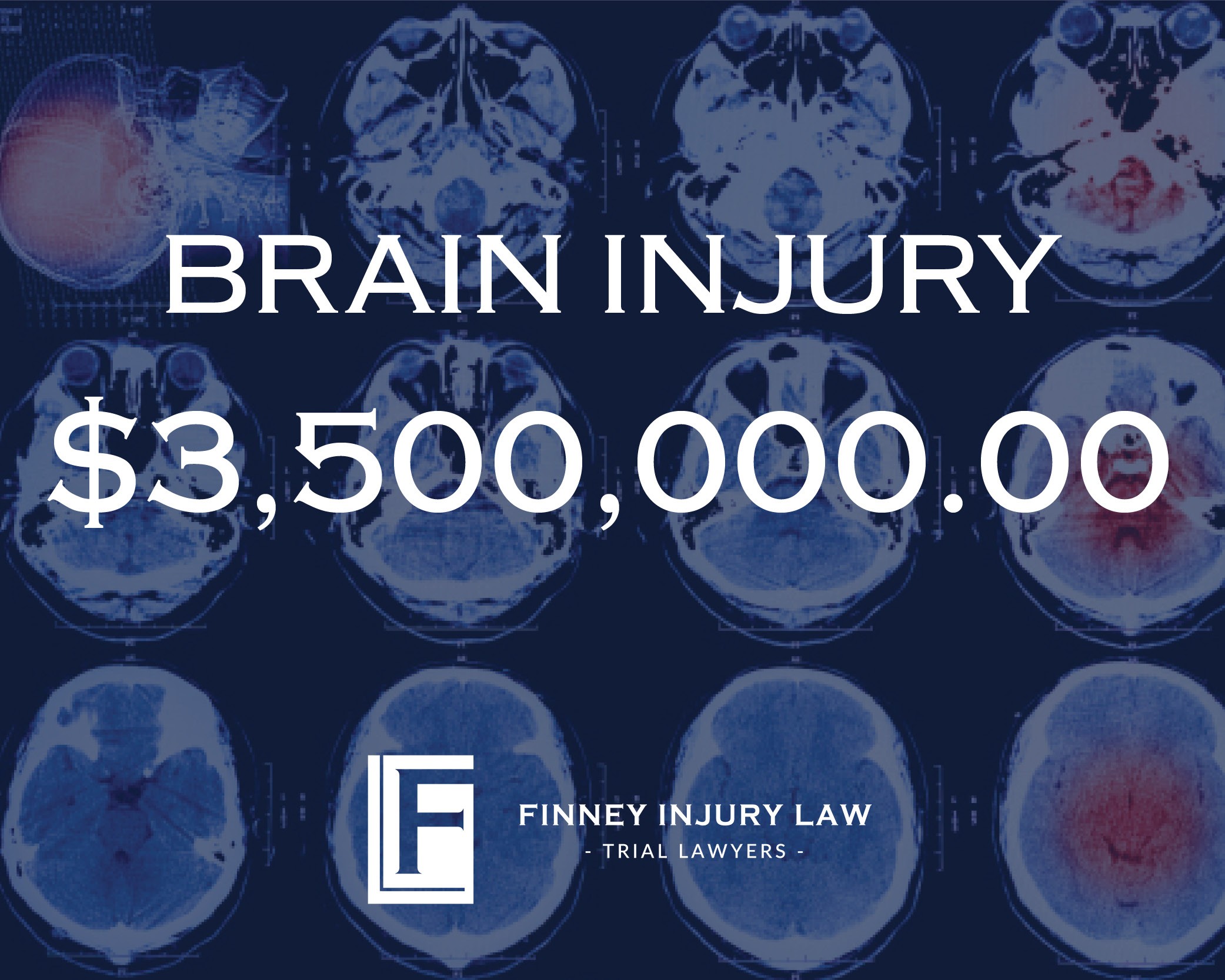3.5 million Brain Injury